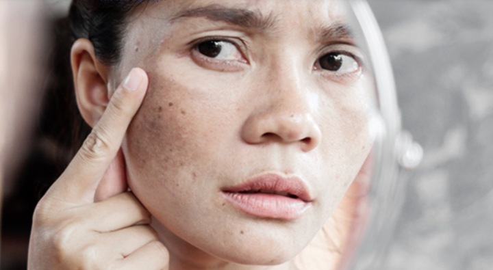 Vết đồi mồi gây mất thẩm mỹ.